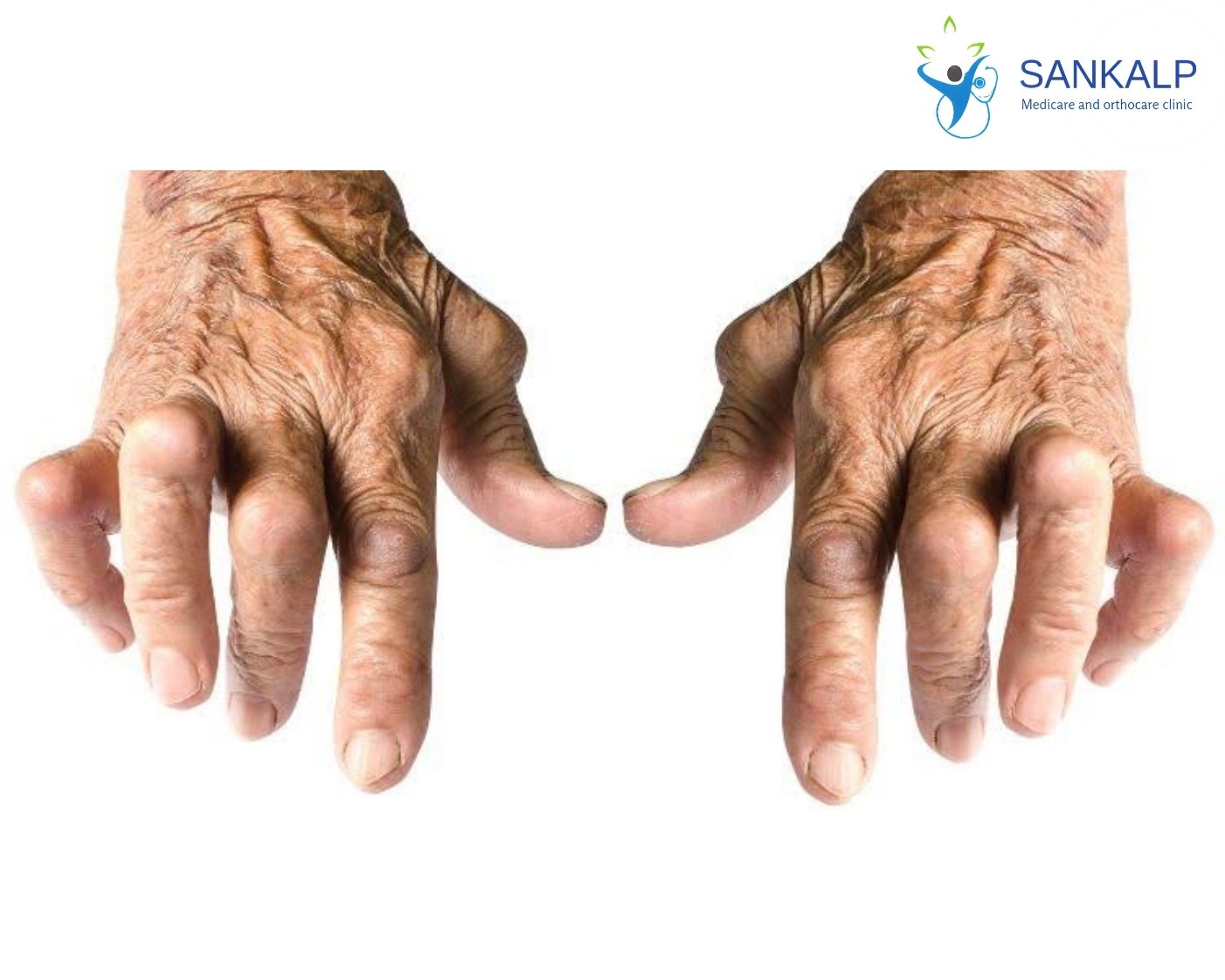 Rheumatoid Arthritis Treatment